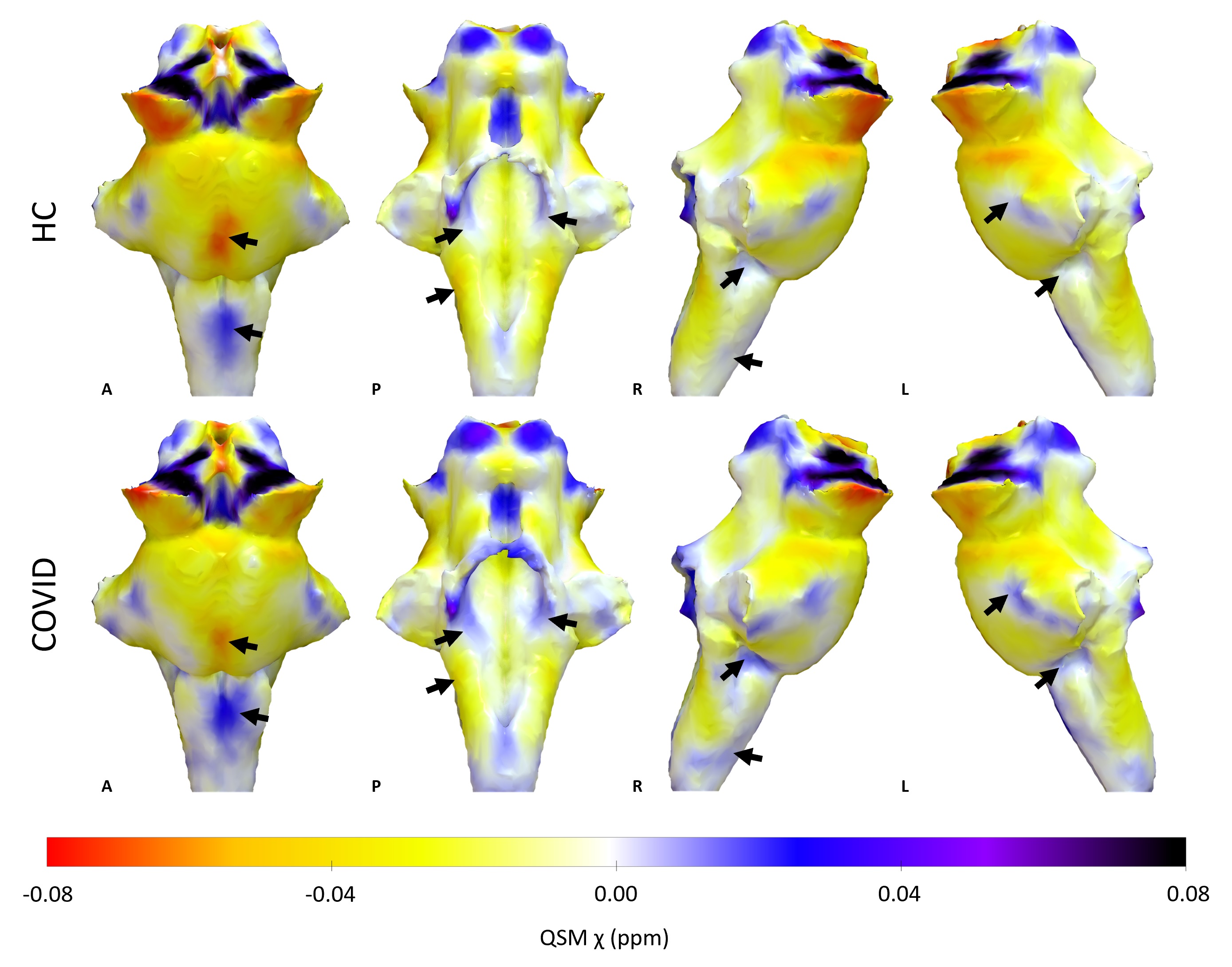 3D projections of the QSM X maps on the rendered brainstem ROI extracted from the FreeSurfer segmentation for the healthy control group and the COVID group. The COVID group shows increased X in the brainstem, specifically in the Medulla and Pons (black arrows).