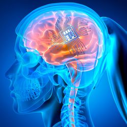 3d rendered image of side profile X-ray of female head with ponytail, the brain is shown in shades of orange and there is an electrode array attached to its surface