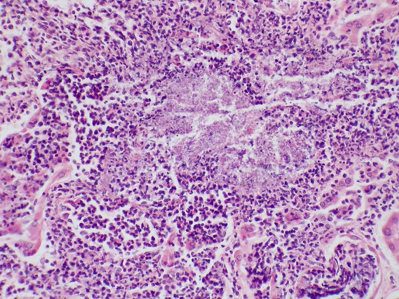 Abscess containing a colony of Candida