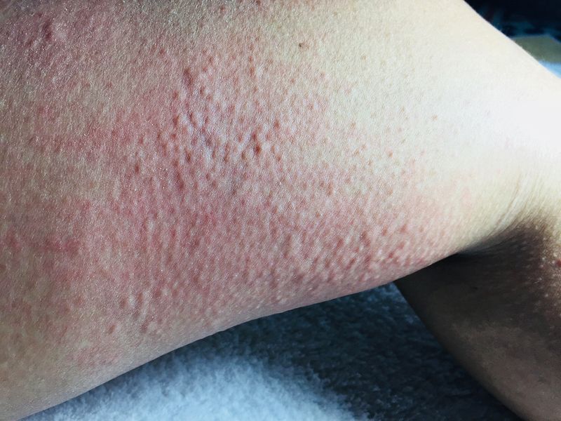 Red rash and bumps hives on a skin arm or leg on a blue blanket