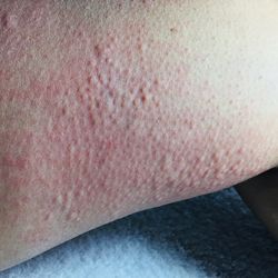 Red rash and bumps hives on a skin arm or leg on a blue blanket