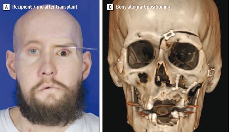 recipient of eye and face transplant photographed 7 months after the surgery; right panel shows 3D scan of skull to demonstrate positioning of bony allograft