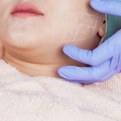 close up of gloved hand illustrating area on person's face where surgery will be performed; lower cheek is crosshatched in white