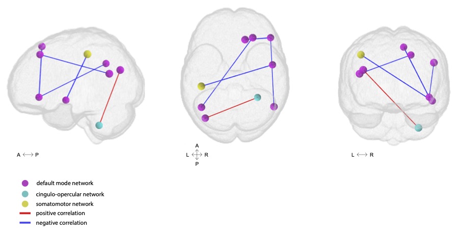 Restless sleep correlates with lower connectivity between the default mode network nodes, and default mode network and somatomotor network nodes. The default mode network is a group of brain regions that are active when we are at rest, not focusing on any specific task. The somatomotor network involves brain regions that are responsible for controlling movement and processing sensations from the body, such as touch and physical feedback.