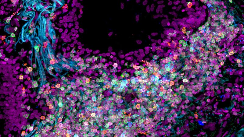 microscope image of human lung tissue with cells labelled in colours from purple to blue to turquoise and pink