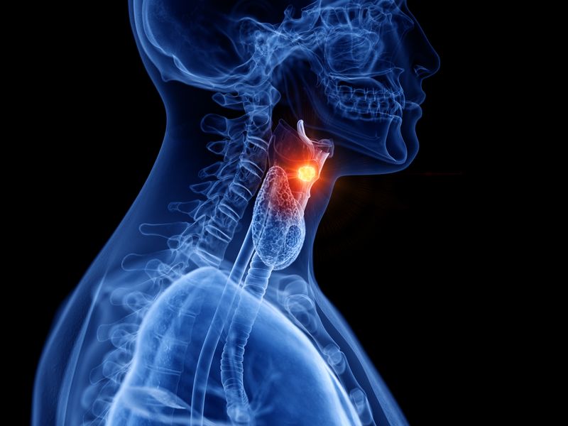 3D rendered diagram of human head and neck in profile, shown in blue on a black background, with a bright yellow tumour on the larynx