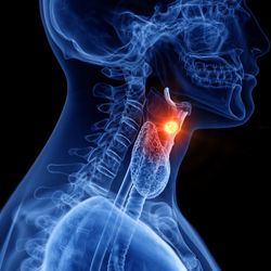 3D rendered diagram of human head and neck in profile, shown in blue on a black background, with a bright yellow tumour on the larynx