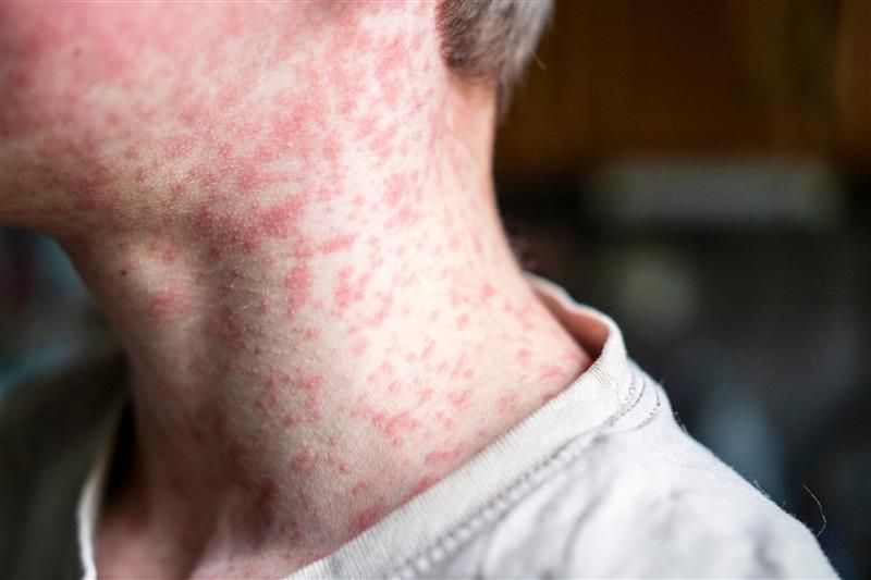 A close up photo of a boy's throat showing the measles rash covering most of his neck and lower face. The photo is limited to just this portion of his body, but it shows just how extensive the rash is. 