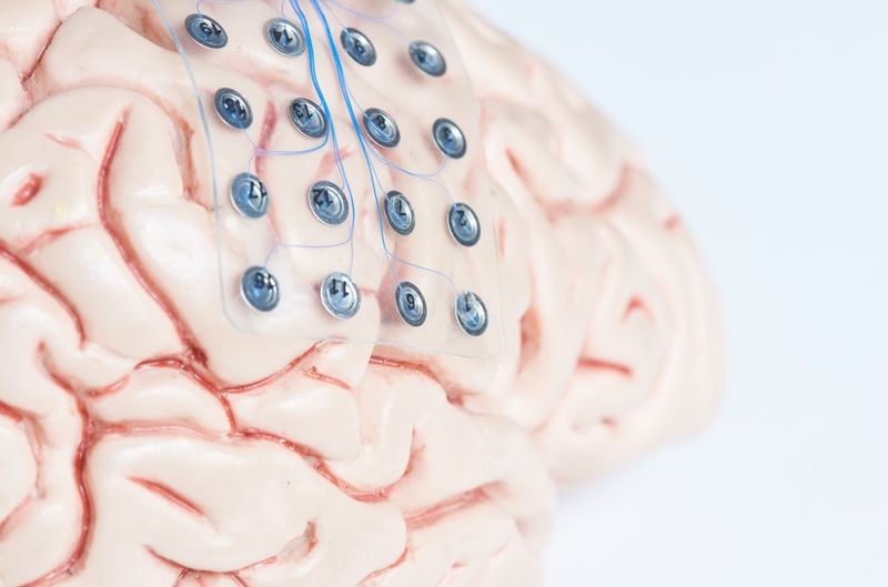 OCD epilepsy brain implant