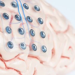 OCD epilepsy brain implant