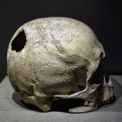 skull with a borehole, evidence of trepanation