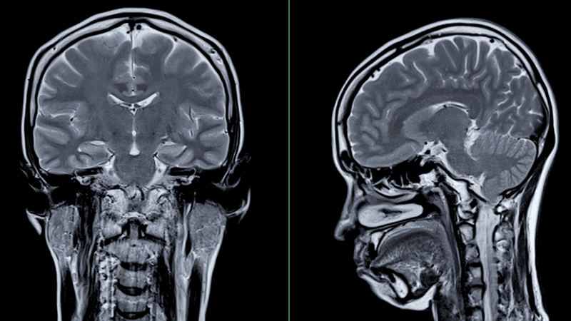 MRI scan of a brain from the back and side