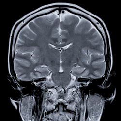 MRI scan of a brain from the back and side