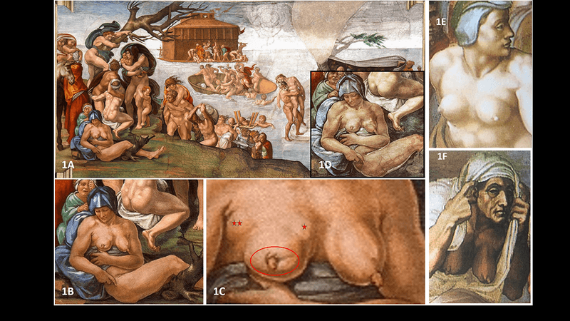 Michelangelo's depiction of The flood (1a), and a woman (1b and 1d) with a breast showing symptoms of cancer 1c. Other works show Michelangelo knew how to depict healthy breasts (1e and f)